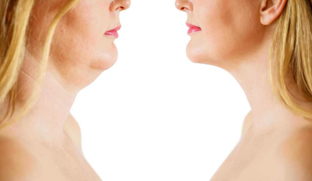 Double Chin treatment Harpenden before and after results