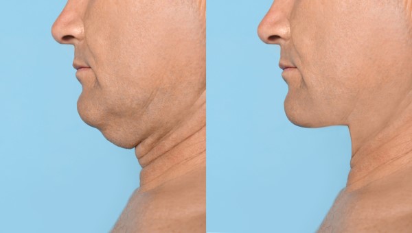 Which Non-Surgical Treatments Work Best for Jowls and Loose Skin Harpenden?
