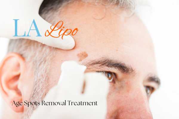 What Are the Most Effective Treatments for Age Spots Harpenden?