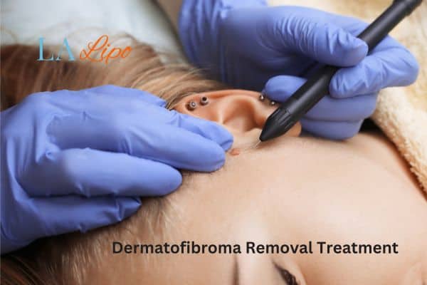 Dermatofibroma Removal Treatment Harpenden