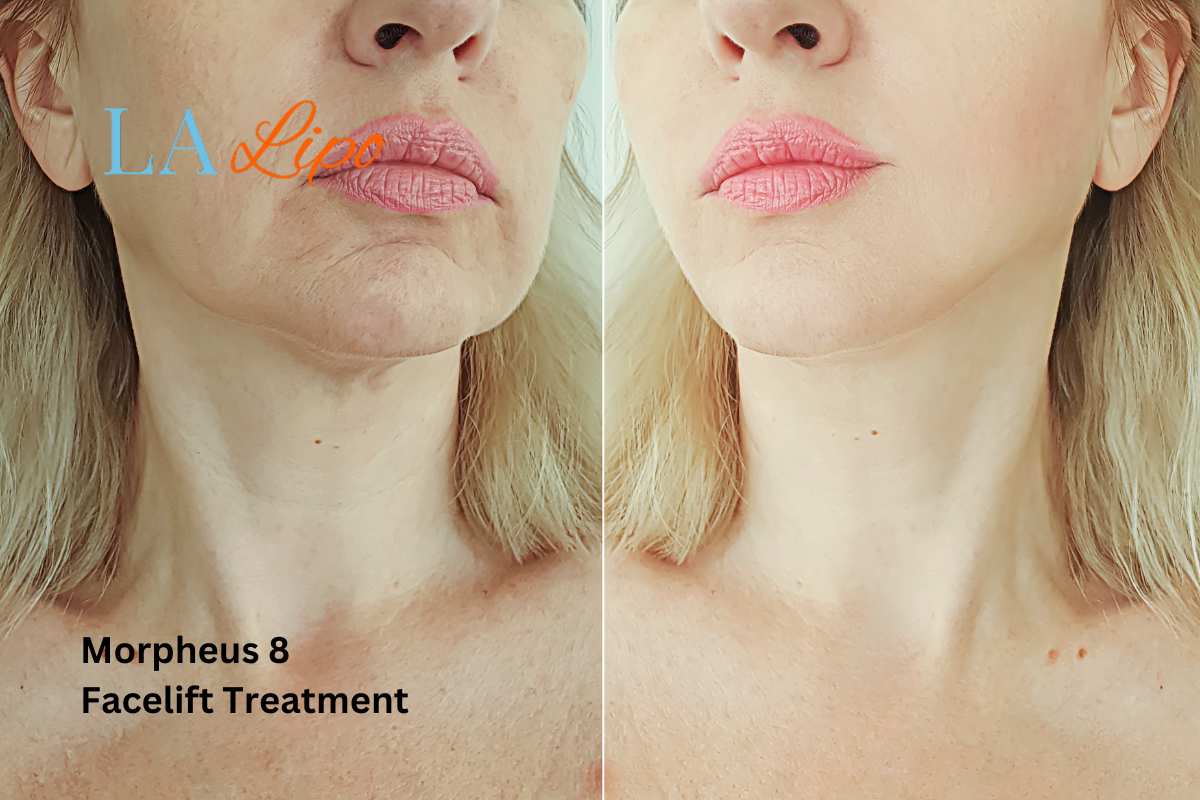 Turn back time with Morpheus8 Treatment Harpenden