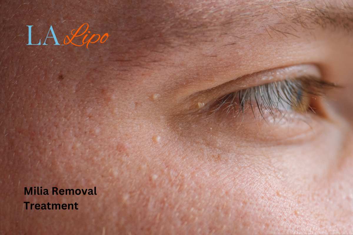 Cryopen Milia Removal: Is It the Easiest and Safest Option Harpenden?