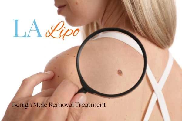 Woman having her inspection of blemish before mole removal Harpenden