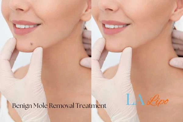 Before and after mole removal Harpenden treatment