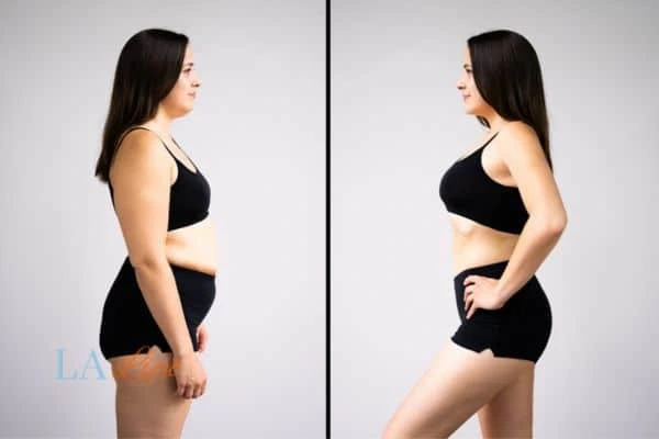 image of woman before and after results of LA-EMS Body Sculpting Harpenden to help treat Diastasis recti