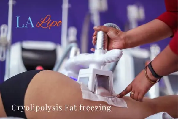 women getting fat freezing Harpenden
