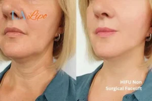 hi-fu for wrinkles Harpenden before and after results