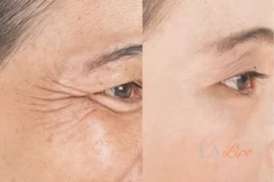 Before and after results of woman - HI-fu wrinkles reduction treatment Harpenden