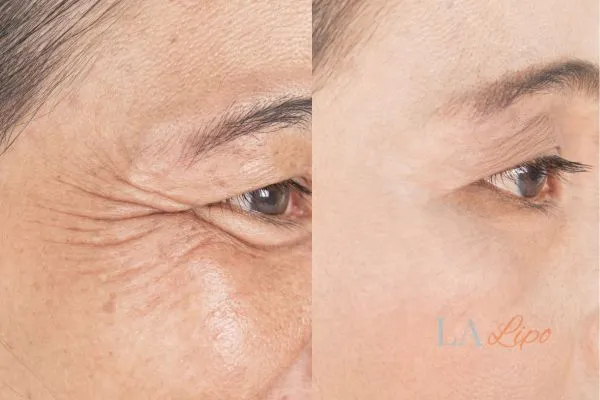 Before and after results of woman - HI-fu wrinkles reduction treatment Harpenden