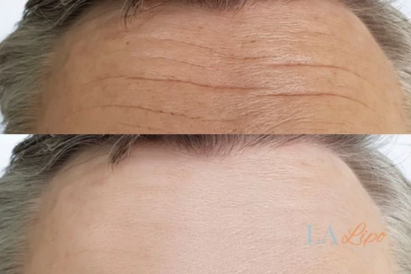 results of HIFU Harpenden on mans forehead to help reduce lines and wrinkles