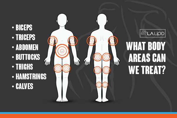 Graphic to show areas you can have LA-EMS Body Sculpting Harpenden treatment.