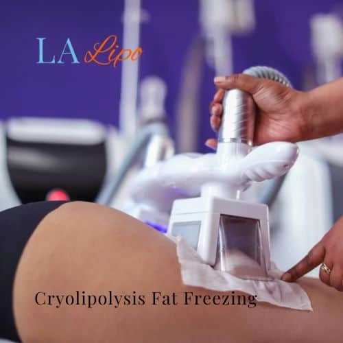 fat freezing - Cryolipolysis Harpenden