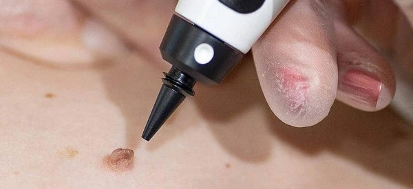 skin tag removal using cryopen Harpenden