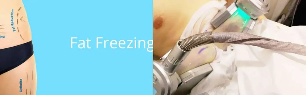 Fat freezing Harpenden on multiple areas of the body