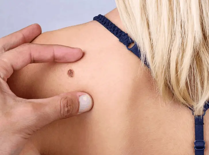 woman having mole removal Harpenden consultation before treatment.