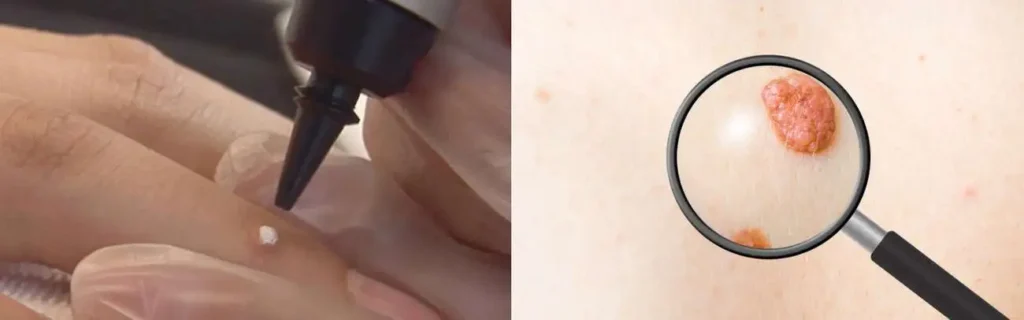 Cryopen for mole removal Harpenden - speak to our team today!