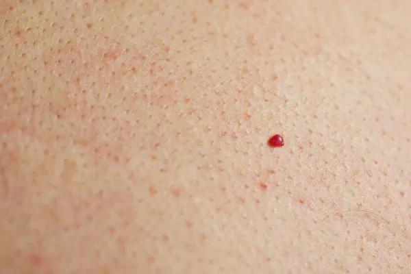 close up of a cherry angioma Harpenden