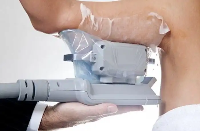Picture of fat freezing Harpenden on the upper arms.