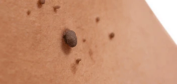 image of a skin tag Harpenden