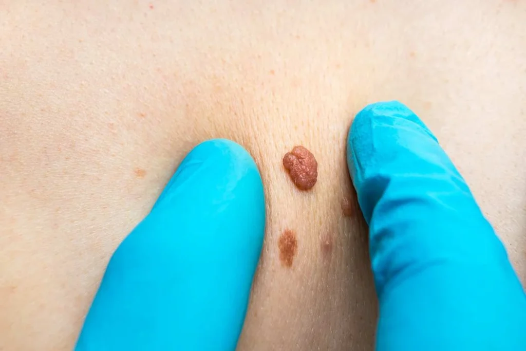 Consultant examining a skin tag Harpenden