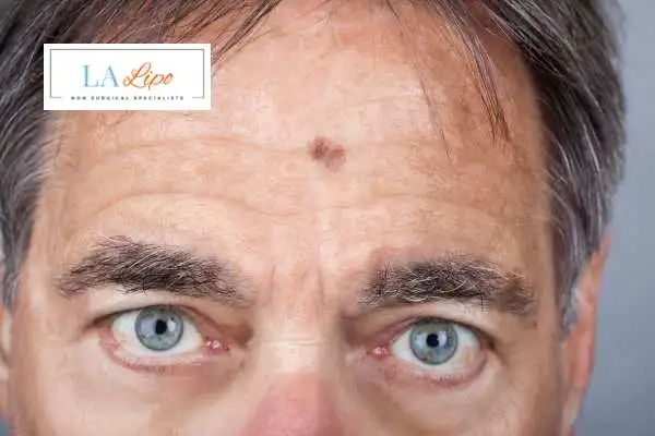 Solar Lentigo Removal Harpenden image of man with mark on his forehead