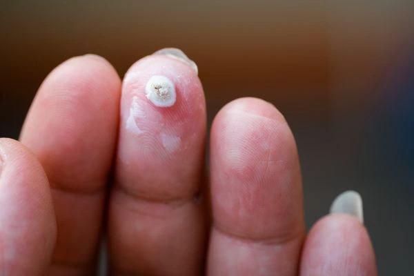 wart on person finger - cryotherapy to treat from LA LIPO Harpenden