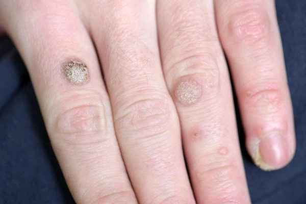 photo of warts on person hand - see wart removal Harpenden from LA LIPO