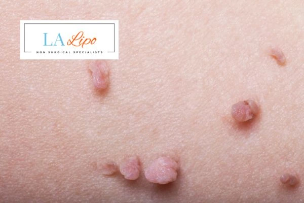 Does cryopen skin tag removal Harpenden hurt? Find out now call our team today!