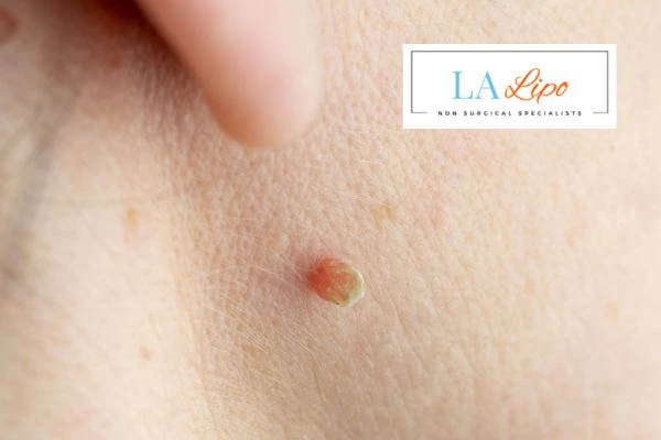 Book skin tag removal Harpenden today speak to our team now!