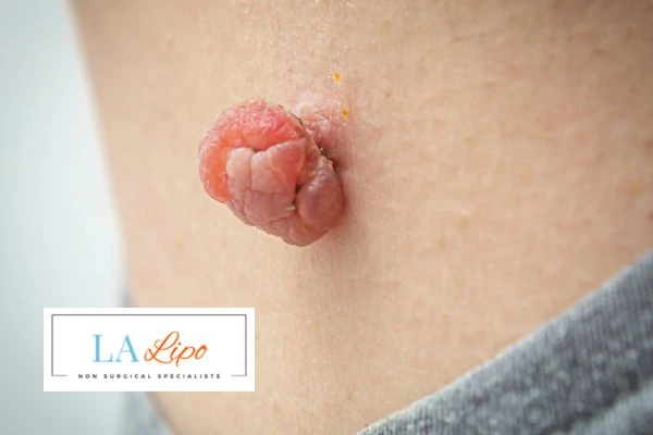 Interested in skin tag removal Harpenden? Concerned about the pain? Find out more today!