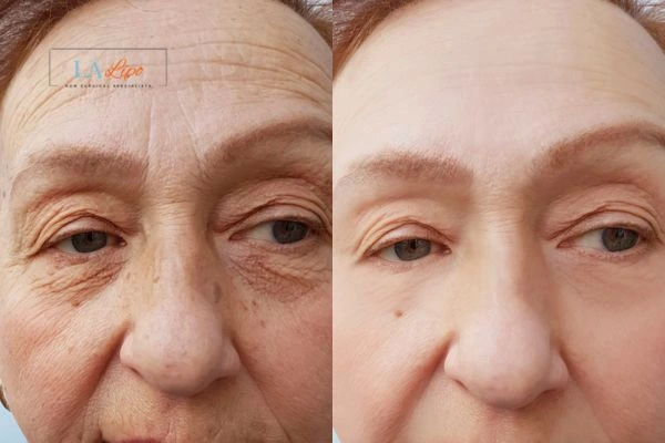 The powerful benefits of Morpheus8 Treatment Harpenden - Call Our team today!