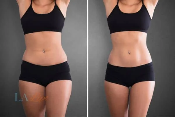 before and after results of non-surgical treatment to help a woman's body image and mental health Harpenden