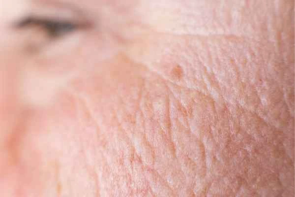 close up picture of a woman's face showing an age spot Harpenden