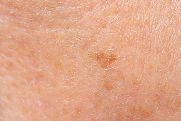 close up picture of age spots Harpenden