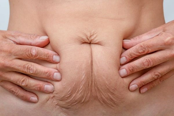 Image of a woman's stomach with loose skin - example of skin tightening Harpenden options