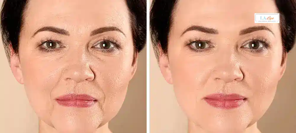 How Long Does It Take to See Results and How Long Do They Last Harpenden?